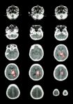 Hemorrhagic Stroke .  Ct Scan (computed Tomography) Of Brain ( C Stock Photo