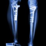 Fracture Tibia(leg Bone) Stock Photo