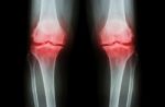 Osteoarthritis Knee ( Oa Knee ). Film X-ray Both Knee ( Front View ) Show Narrow Joint Space ( Joint Cartilage Loss ) , Osteophyte , Subchondral Sclerosis Stock Photo
