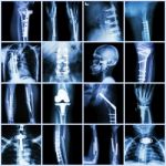 Collection X-ray Orthopedic Surgery (multiple Part Of Human, Operate And Internal Fixation By Plate&screw ) Stock Photo