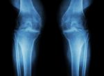 Osteoarthritis Knee ( Oa Knee ) ( Film X-ray Both Knee With Arthritis Of Knee Joint : Narrow Knee Joint Space ) ( Medical And Science Background ) Stock Photo