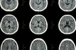Ct Scan Of Brain Show Normal Brain ( Neurological Background )ct Scan Of Brain Show Normal Brain ( Neurological Background ) Stock Photo