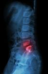 Lumbar Spine Of Child And Inflammation At Lumbar Spine ( Low Back Pain ) ( X-ray Thoracic - Lumbar Spine ) ( Lateral View ) Stock Photo