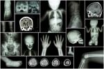 X-ray Multiple Part Of Child 's Body & Multiple Disease ( Stroke , Brain Tumor , Rheumatoid Arthritis , Sinusitis , Gouty Arthritis , Etc)( Skull Chest Lung Heart Spine Arm Hand Pelvis Leg Knee Foot ) Stock Photo