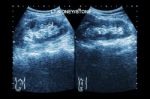 Ultrasonography Of Kidney : Show Left Kidney Stone ( 2 Image For Compare ) Stock Photo