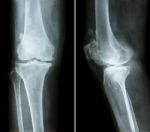 Osteoarthritis Knee .  Film X-ray Knee ( Anterior - Posterior And Lateral View )  Show Narrow Joint Space , Osteophyte ( Spur ) , Subcondral Sclerosis Due To Degenerative Change Stock Photo