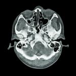 Ct Scan Of Brain And Base Of Skull  ( Bone Window ) Stock Photo
