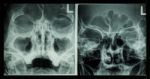 Film X-ray Paranasal Sinus Show Frontal Sinus , Maxillary Sinus , Ethmoid Sinus Stock Photo