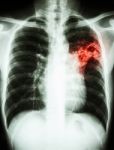 Mycobacterium Tuberculosis Infection (pulmonary Tuberculosis) Stock Photo