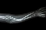 Fracture Shaft Of Ulnar(forearm's Bone) Stock Photo