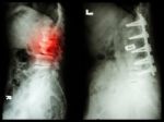 "spondylosis" (left Image) , Patient Was Operated And Internal Fixed. (right Image) In Old Man Stock Photo
