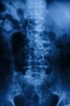 "spondylosis"  Film X-ray : Lumbar Spine With Spur & Collapse At Stock Photo