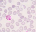 Blood Films For Malaria Parasite Stock Photo