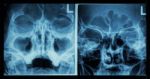 Film X-ray Paranasal Sinus Show Frontal Sinus , Maxillary Sinus , Ethmoid Sinus Stock Photo