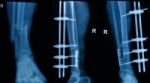 Collection Of Human X-rays  Showing Fracture Of Right Leg , Pre And Post  Operated With External Fixed By Plate And Screw Stock Photo