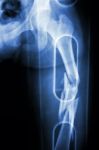 Film X-ray Show Comminute Fracture Shaft Of Femur (thigh Bone). It Was Spliced Stock Photo
