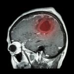 Film Mri Of Brain With Brain Tumor ( Sagittal Plane , Side View , Lateral View ) ( Medical , Health Care , Science Background ) Stock Photo