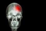 Stroke ( Cerebrovascular Accident ) . Film X-ray Skull Of Human With Red Area ( Medical , Science And Healthcare Concept And Background ) Stock Photo