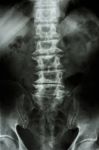 Spondylosis Stock Photo