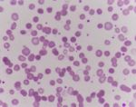 Abnormal Red Blood Cells Stock Photo