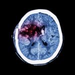 Ct Scan Of Brain : Show Old Right Basal Ganglia Hemorrhage With Brain Edema ( Status Post Craniotomy ) ( Hemorrhagic Stroke ) Stock Photo
