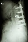 Lumbar Spine With Pedicle Screw Fixation Stock Photo