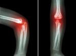 Rheumatoid Arthritis , Gouty Arthritis ( Film X-ray Child 's Elbow With Arthritis At Elbow ) ( Side And Front View , Lateral And Anterior - Posterior View ) ( 2 Position ) Stock Photo