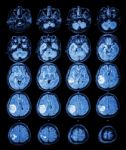 Mri Brain : Brain Tumor At Right Parietal Lobe Stock Photo