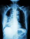 Lung Cancer .  Film Chest X-ray Show Right Lung Mass , Wide Mediastinum , Pneumonia And Right Pleural Effusion Stock Photo