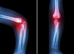 Rheumatoid Arthritis , Gouty Arthritis ( Film X-ray Child 's Elbow With Arthritis At Elbow ) ( Side And Front View , Lateral And Anterior - Posterior View ) ( 2 Position ) Stock Photo
