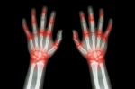 Rheumatoid Arthritis , Gout Arthritis  ( Film X-ray Both Hands Of Child With Multiple Joint Arthritis ) ( Medical , Science And Health Care Concept ) Stock Photo
