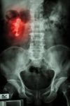 Right Renal Calculi (staghorn) Stock Photo