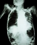 Pulmonary Tuberculosis With Acute Respiratory Failure ( Film Chest X-ray Of Old Patient Show Alveolar And Interstitial Infiltration Both Lung With Endotracheal Tube ) Due To Mycobacterium Tuberculosis Stock Photo