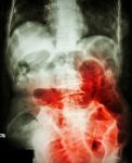 Small Bowel Obstruction.  Film X-ray Abdomen Supine :  Show Small Bowel Dilated Due To Small Bowel Obstruction Stock Photo