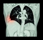 Lung Cancer ( Ct Scan Of Chest And Abdomen : Show Right Lung Cancer ) ( Coronal Plane ) Stock Photo