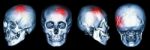 Ct Scan Of Human Skull And 3d With Stroke (cerebrovascular Accident) Stock Photo