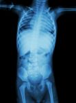 Film X-ray Whole Body Of Child ( Medical , Science And Healthcare Concept ) Stock Photo
