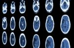 Film Ct Scan Of Brain Show Ischemic Stroke And Hemorrhagic Strok Stock Photo