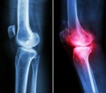 Normal Knee ( Left Image ) And Osteoarthritis Knee ( Right Image ) ( Lateral View ) Stock Photo
