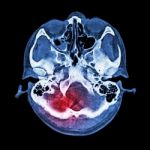 Brain Injury, Stroke : ( Ct Scan Of Brain And Base Of Skull ) ( Bone Window ) Stock Photo