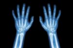 Film X-ray Normal Both Hands Of Child Stock Photo