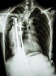 Scoliosis Patient Was Operated And Internal Fixed At Thoracic Sp Stock Photo