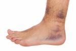 Ankle Sprain Stock Photo