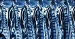 Cervical Spondylosis With Disc Herniation ( Mri Of Cervical Spine : Show Cervical Spondylosis With Disc Herniation Compress Spinal Cord ( Myelopathy ) ) Stock Photo