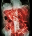 Bowel Obstruction ( X-ray Abdomen Supine Position : Large Bowel Stock Photo