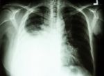 Pleural Effusion Due To Lung Cancer Stock Photo