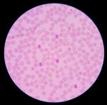 Blood Films For Malaria Parasite.showing Pink Cells Malaria Pigm Stock Photo