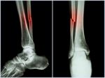 Fracture Shaft Of Fibula Bone ( Leg Bone ) .  X-ray Of Leg ( 2 Position : Side And Front View ) Stock Photo