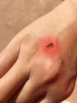 Mosquito Sucking Blood On Human Skin With Red Spot Stock Photo