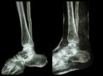 Left Image : Fracture Shaft Of Fibula (calf Bone)  ,  Right Image : It Was Splinted With Plaster Cast Stock Photo